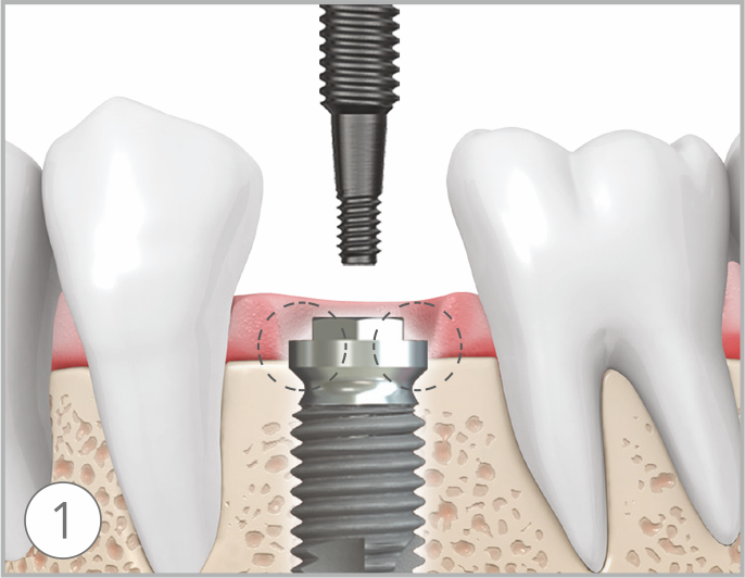 How to remove failed implants step1