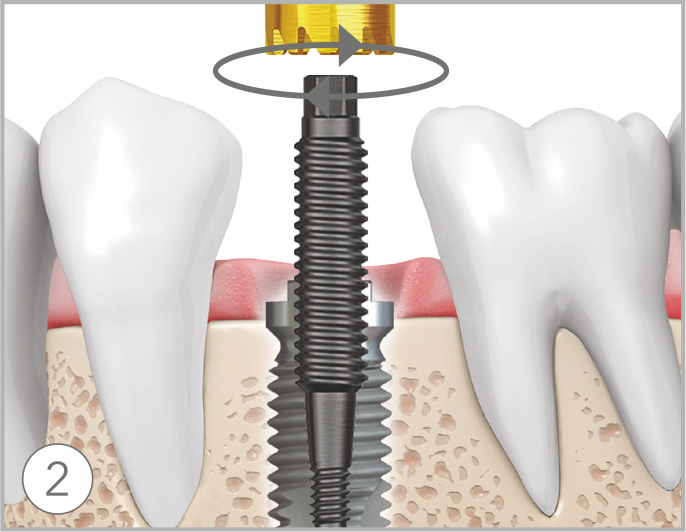 Right turn close How to remove failed implants step2