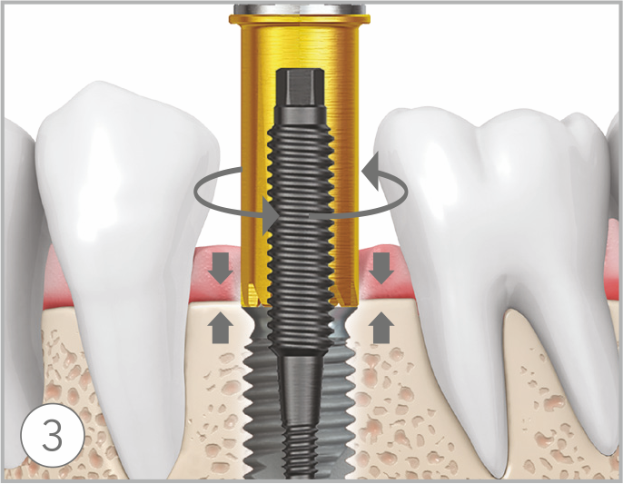 Left turn close How to remove failed implants step3