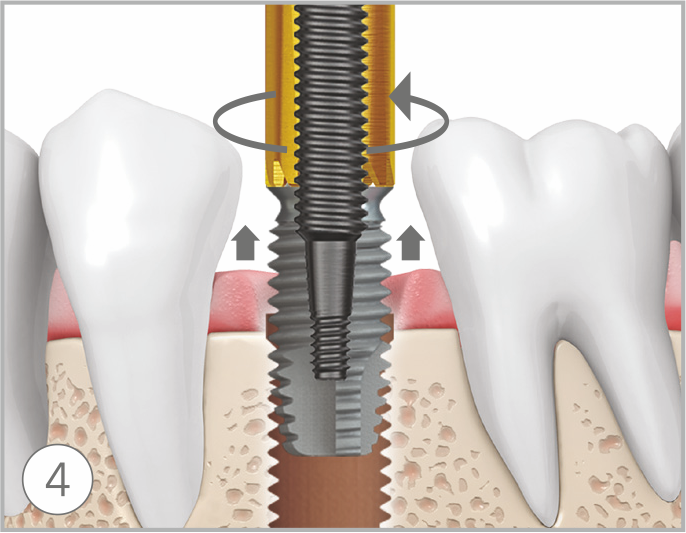 How to remove failed implants step4