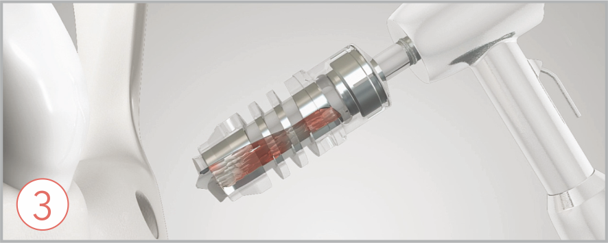 Drilling how to use ACM 3