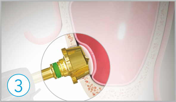 Bone Disk how to use sla kit 3