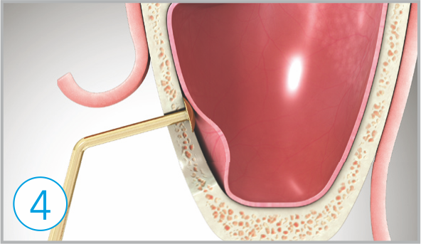 Detach sinus membrane how to use sla kit 4