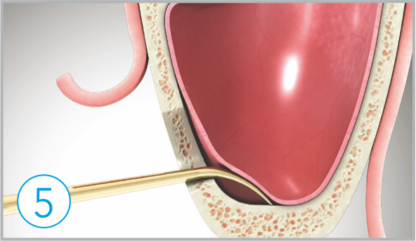 Elevate sinus membrane how to use sla kit 5