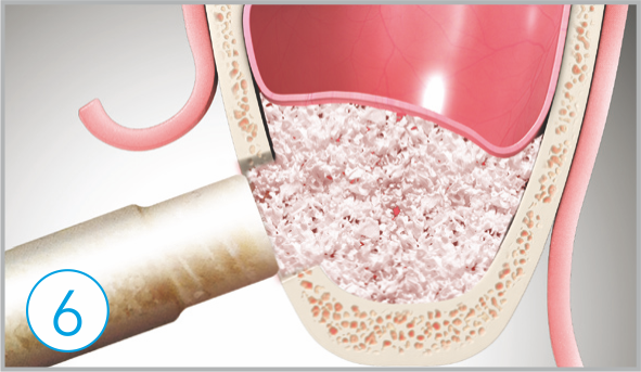 Bone graft how to use sla kit 6