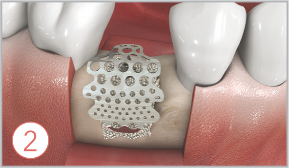Bone graft & CTi-mem how to use EZ-GBR 2