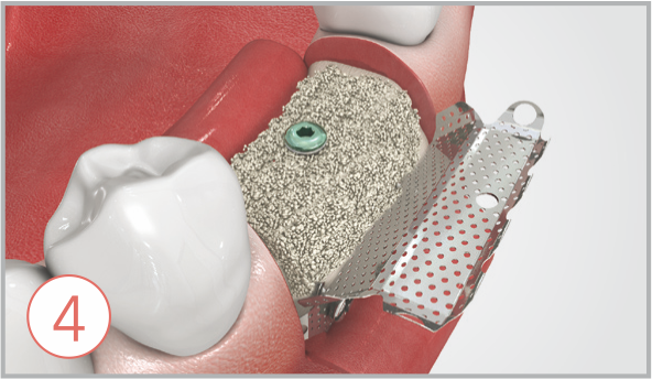Bone graft how to use GBR kit 4