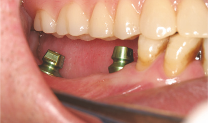 Attach a Coping to a Fixture implanted in the oral cavity. pickcap impression kit how to step 1