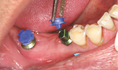Attach a Cap to the Coping pickcap impression kit how to step 3