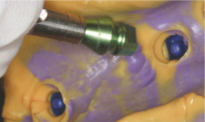 Reposition the Coping on impression body. pickcap impression kit how to step 6